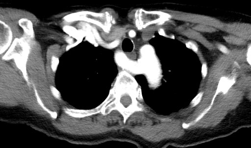 dysphagia lusoria