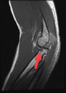 sagittal weighted tse