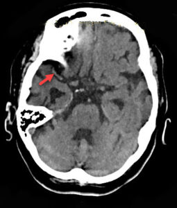 Mca Occlusion Stroke Mca Segments Radiology Radiology For Beginners Mca Occlusion Stroke Mca Segments Radiology Radiology For Beginners