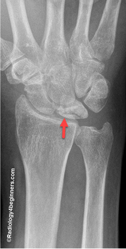 Morbus Kienböck Stage II
It shows increased density in the lunate on plain radiographs
without a change in the shape, size, or relationship to other
carpal bones.