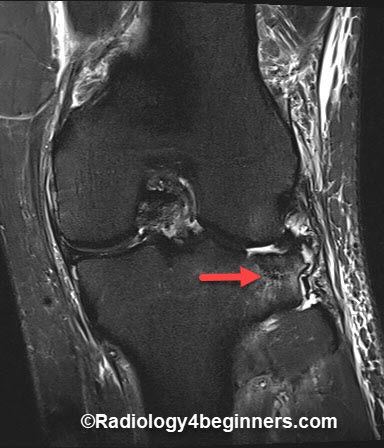 Avulsion fracture of the knee involving the lateral aspect of the proximal tibial plateau. 
Very frequently associated with disruption or tear of the anterior cruciate ligament.