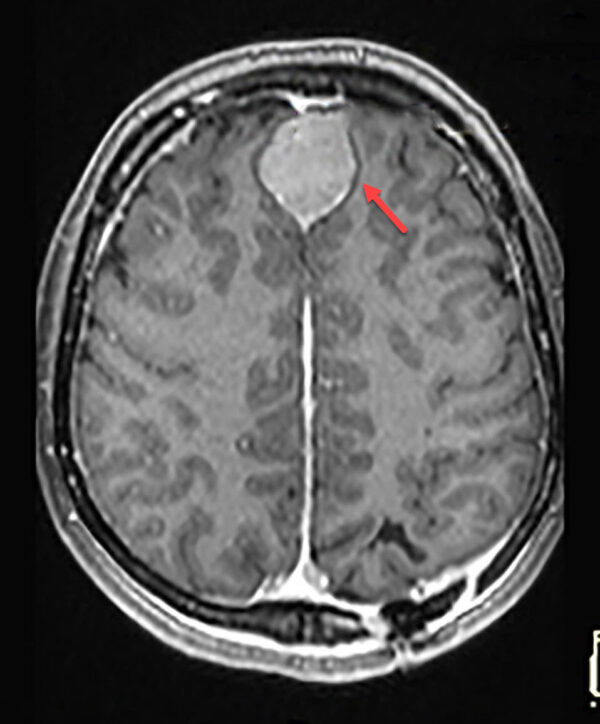 Neurofibromatosis II - Radiology For Beginners by Dr. Samuel Kobba