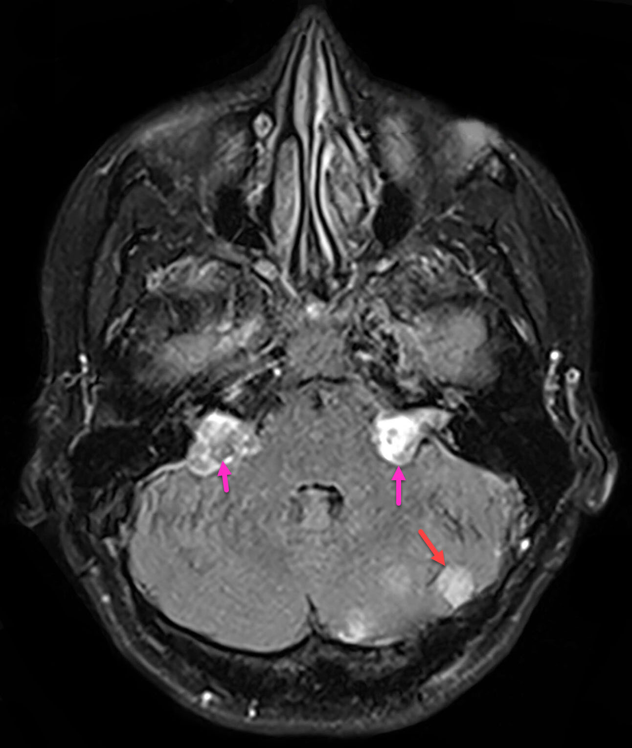 Neurofibromatosis II - Radiology For Beginners by Dr. Samuel Kobba
