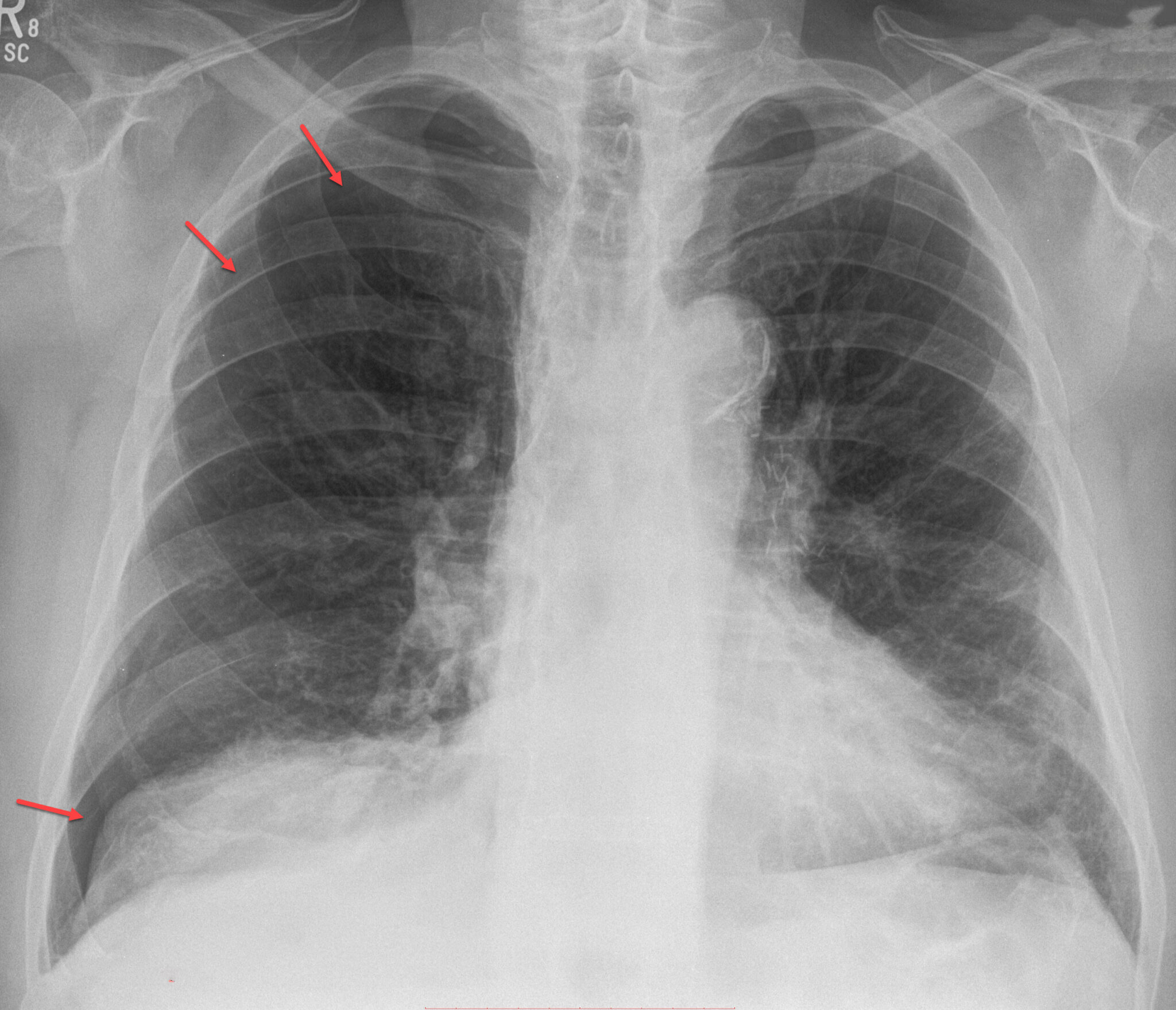 Pneumothorax Radiology For Beginners by Dr. Samuel Kobba