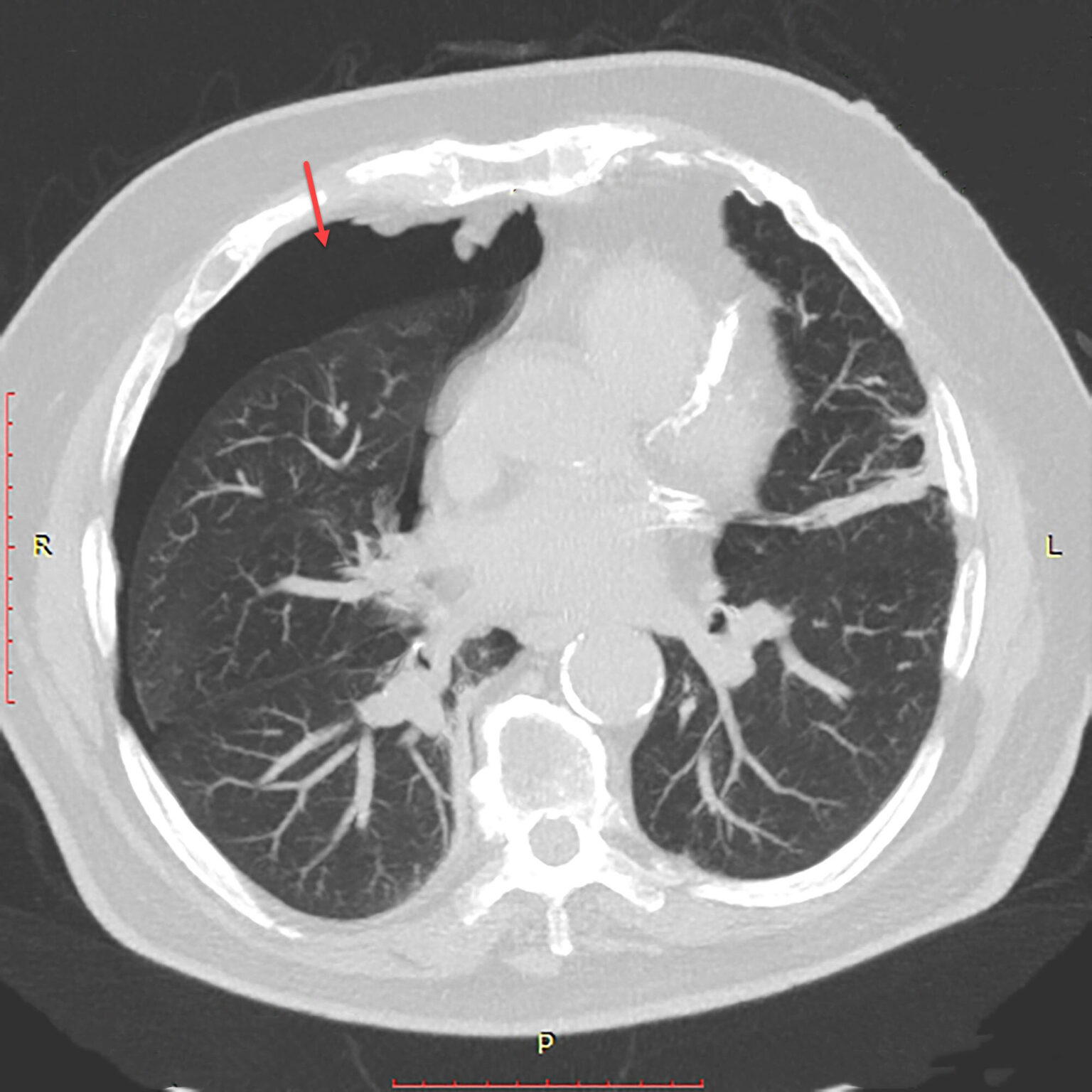 Pneumothorax Radiology For Beginners by Dr. Samuel Kobba