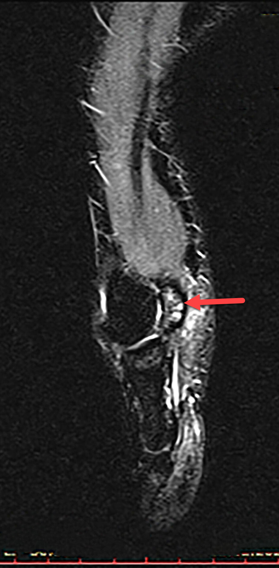 Sesamoiditis - Radiology For Beginners by Dr. Samuel Kobba
