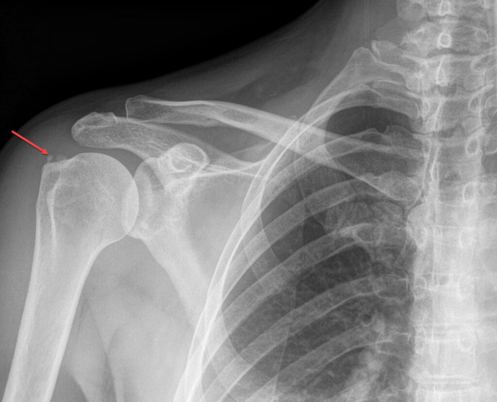 Calcific tendinitis also 
Calcific tendinosis