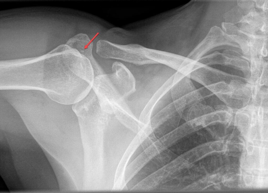 Calcific tendinitis
Calcific tendinosis 