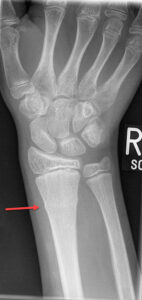 buckle fracture buckle fracture